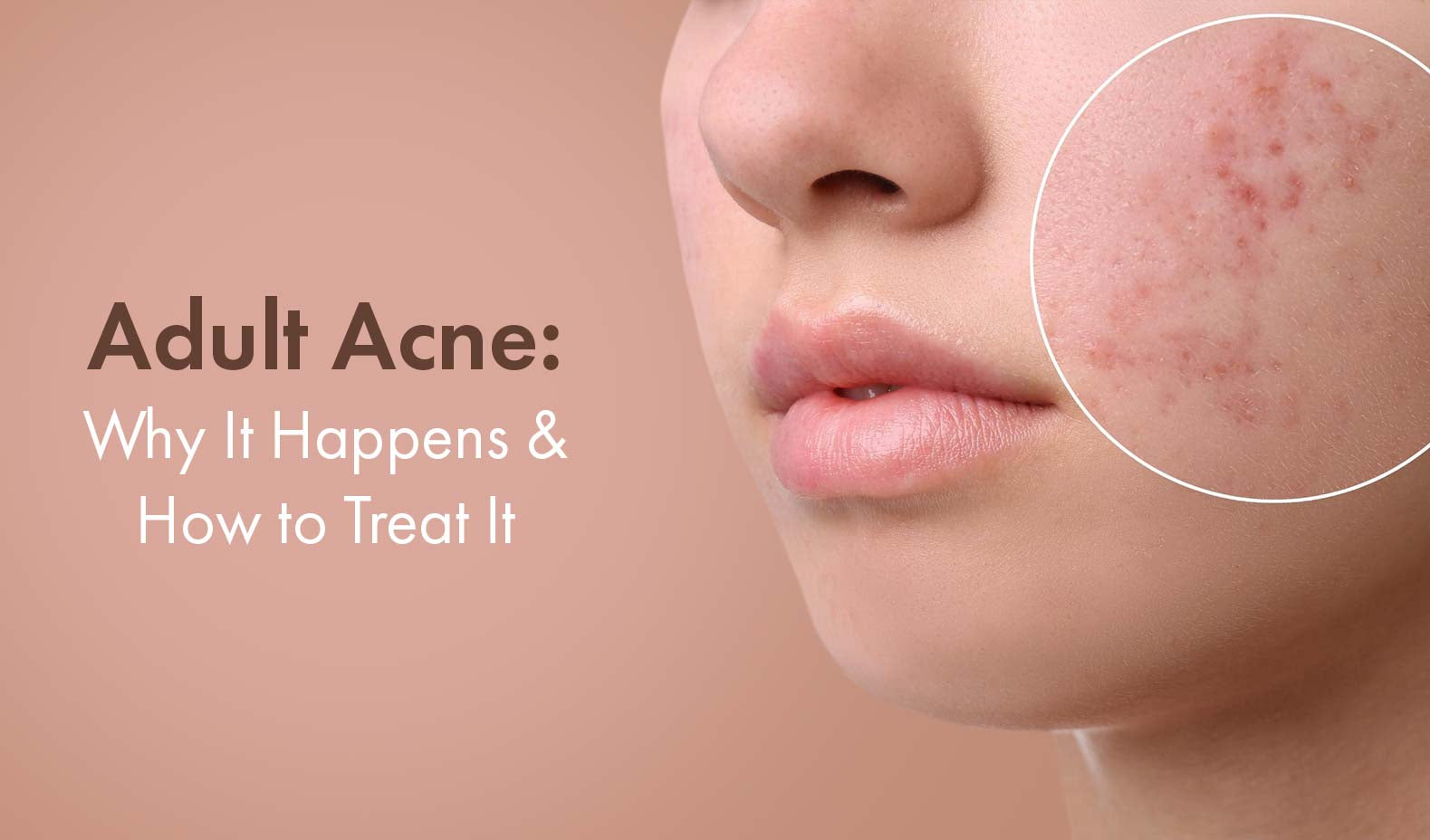 Dealing with Adult Acne: Why It Happens and How to Treat It