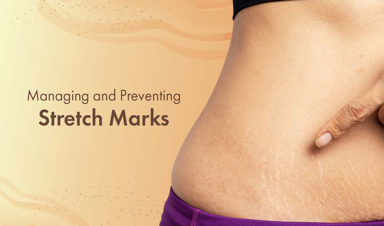 Managing and Preventing Stretch Marks: Tips and Tricks