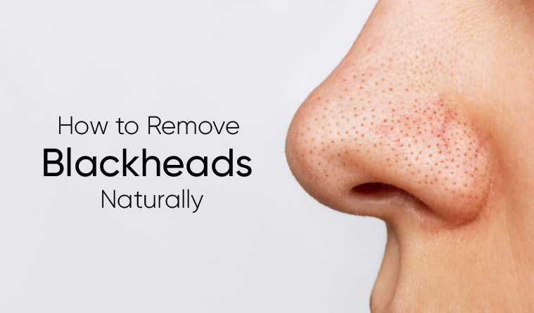 How to Remove Blackheads Naturally