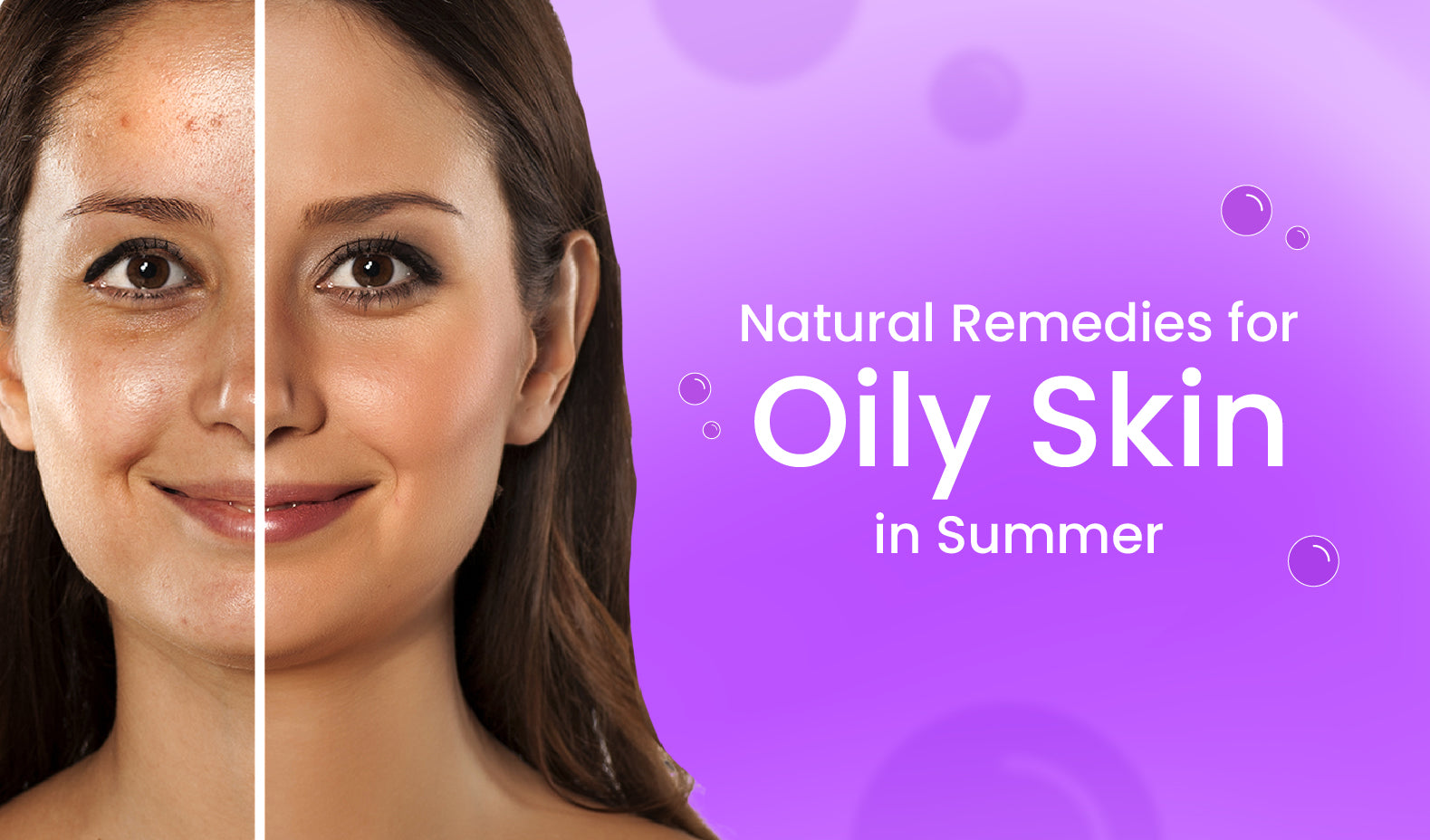 Natural Remedies for Oily Skin in Summer