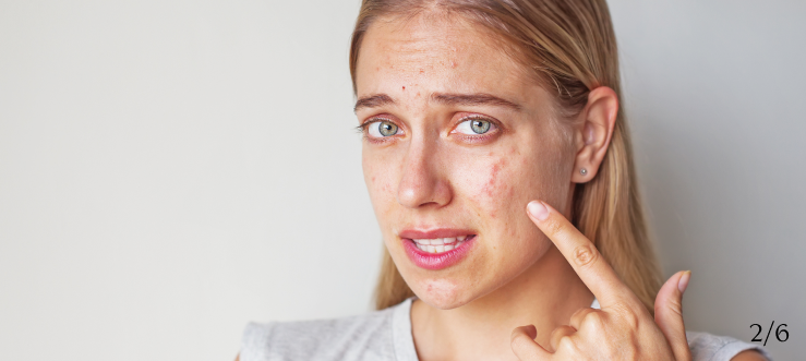 Worsening of acne Cause Image
