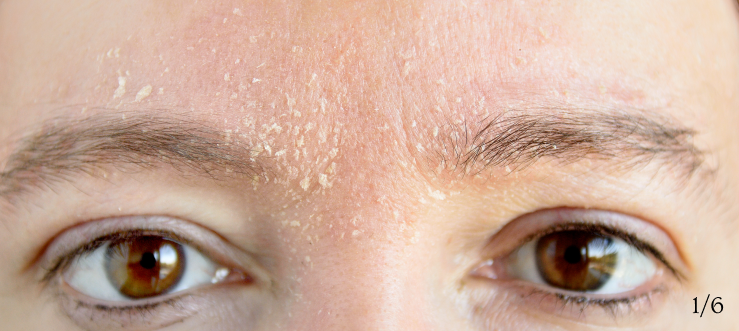 Extreme dryness, redness, and peeling Cause Image